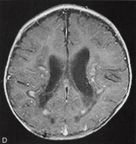 【病例】肾上腺脑白质营养不良1例MR影像表现 【病例】肾上腺脑白质营养不良1例MR影像表现