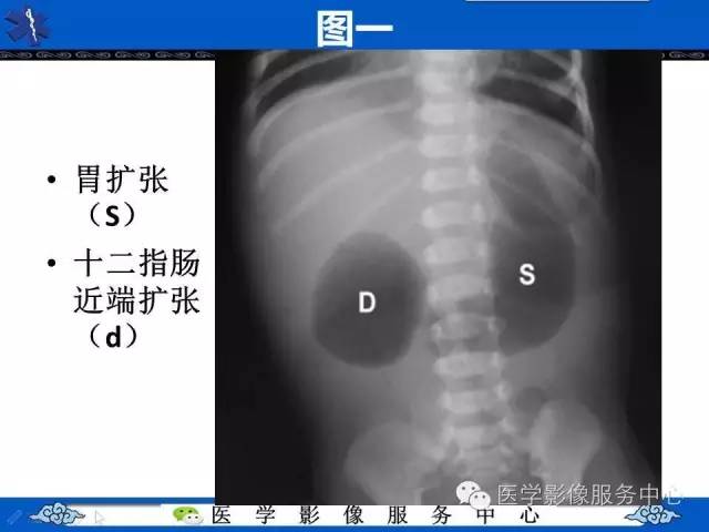 【影像征象】双泡征