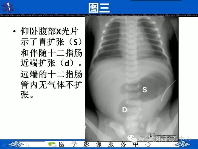 【影像征象】双泡征