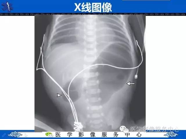【影像征象】双泡征