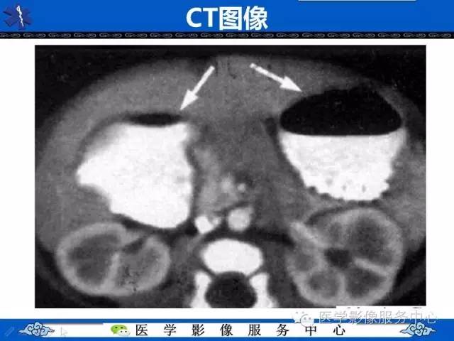【影像征象】双泡征