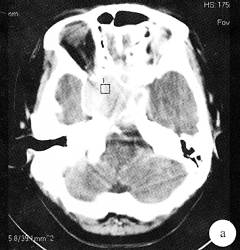 【病例】侵袭性垂体腺瘤1例MR影像表现 【病例】侵袭性垂体腺瘤1例MR影像表现