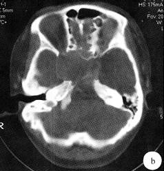 【病例】侵袭性垂体腺瘤1例MR影像表现 【病例】侵袭性垂体腺瘤1例MR影像表现