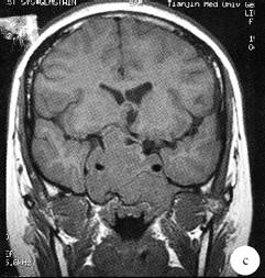 【病例】侵袭性垂体腺瘤1例MR影像表现 【病例】侵袭性垂体腺瘤1例MR影像表现