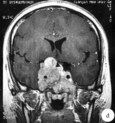 【病例】侵袭性垂体腺瘤1例MR影像表现
