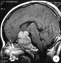 【病例】侵袭性垂体腺瘤1例MR影像表现 【病例】侵袭性垂体腺瘤1例MR影像表现