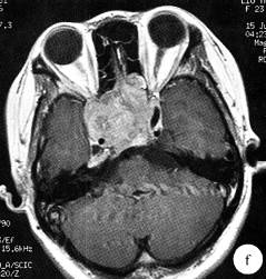 【病例】侵袭性垂体腺瘤1例MR影像表现 【病例】侵袭性垂体腺瘤1例MR影像表现