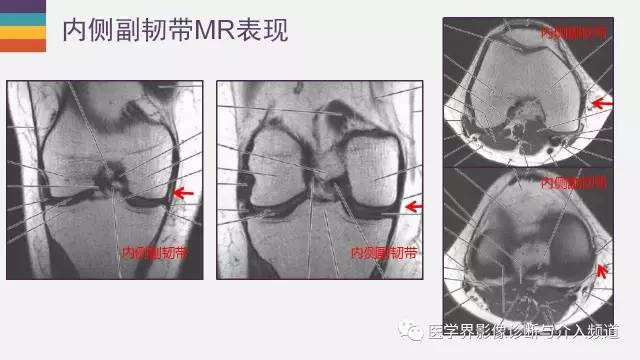【PPT】膝关节内侧副韧带解剖及损失MR诊断
