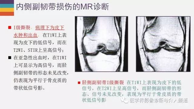 【PPT】膝关节内侧副韧带解剖及损失MR诊断
