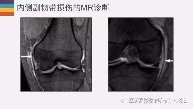 【PPT】膝关节内侧副韧带解剖及损失MR诊断