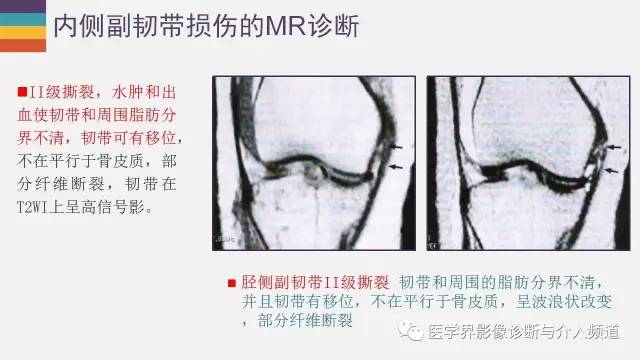 【PPT】膝关节内侧副韧带解剖及损失MR诊断