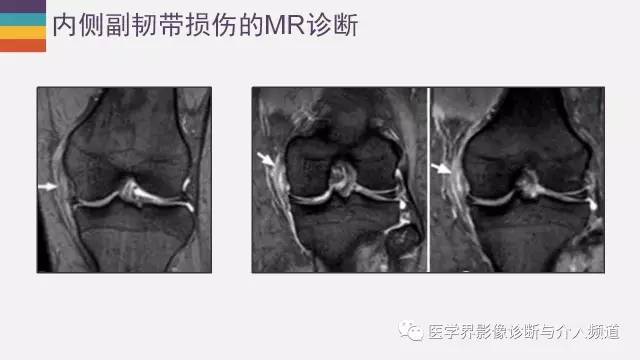 【PPT】膝关节内侧副韧带解剖及损失MR诊断