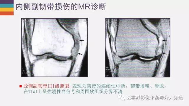 【PPT】膝关节内侧副韧带解剖及损失MR诊断