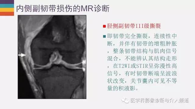 【PPT】膝关节内侧副韧带解剖及损失MR诊断