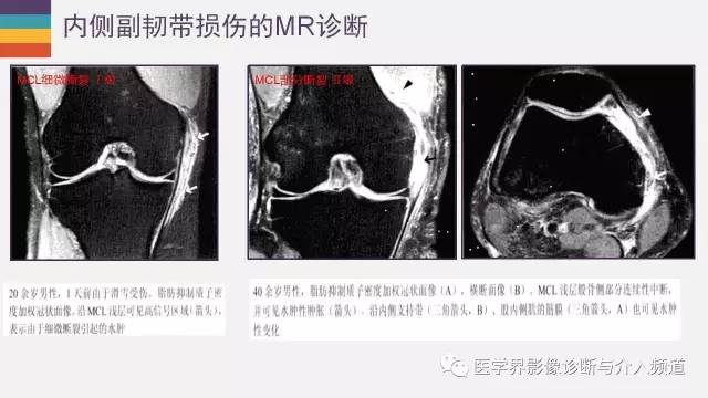 【PPT】膝关节内侧副韧带解剖及损失MR诊断