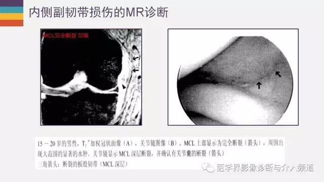【PPT】膝关节内侧副韧带解剖及损失MR诊断