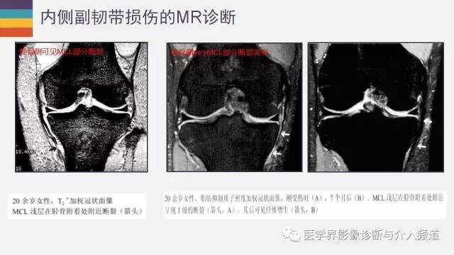 【PPT】膝关节内侧副韧带解剖及损失MR诊断