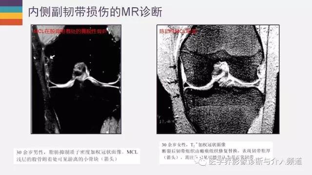 【PPT】膝关节内侧副韧带解剖及损失MR诊断