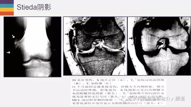【PPT】膝关节内侧副韧带解剖及损失MR诊断