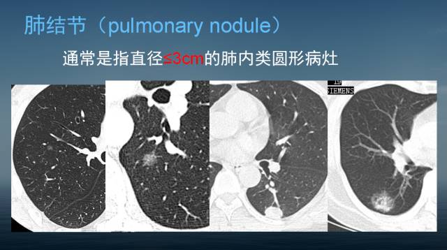 【PPT】孤立性肺结节的CT诊断--肺癌