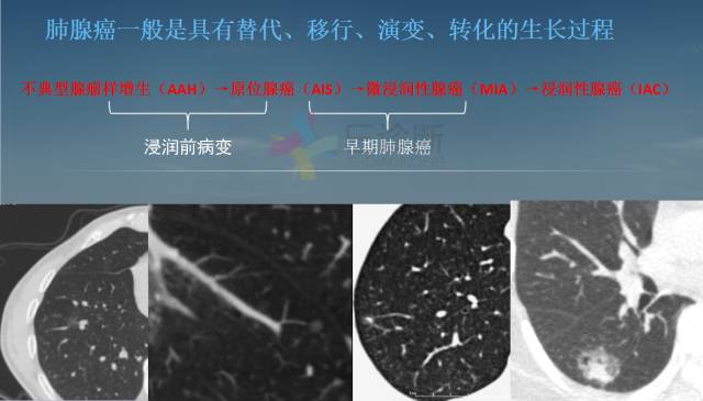 【PPT】孤立性肺结节的CT诊断--肺癌