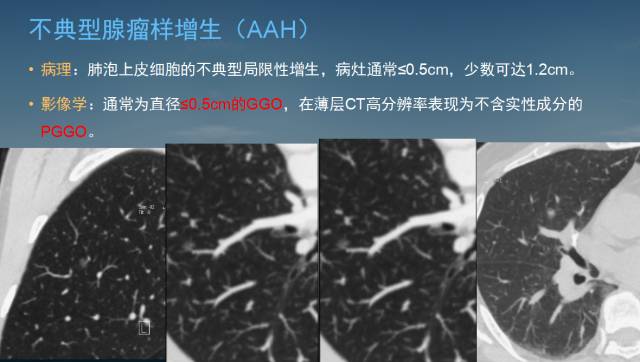【PPT】孤立性肺结节的CT诊断--肺癌