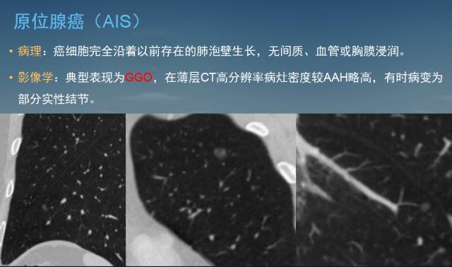 【PPT】孤立性肺结节的CT诊断--肺癌