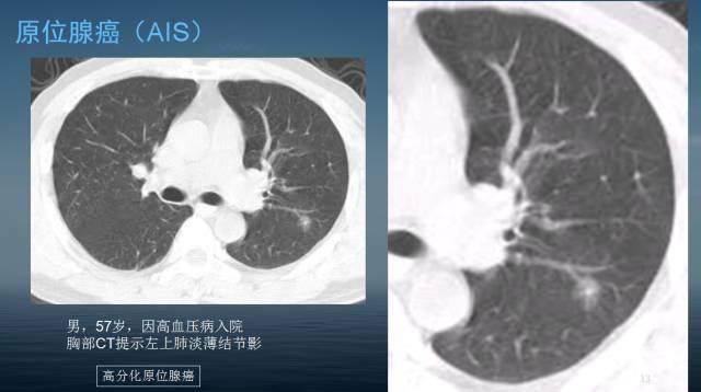 【PPT】孤立性肺结节的CT诊断--肺癌