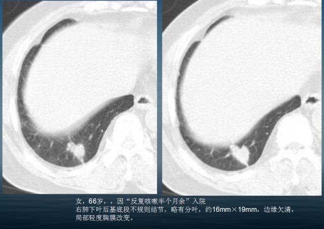 【PPT】孤立性肺结节的CT诊断--肺癌