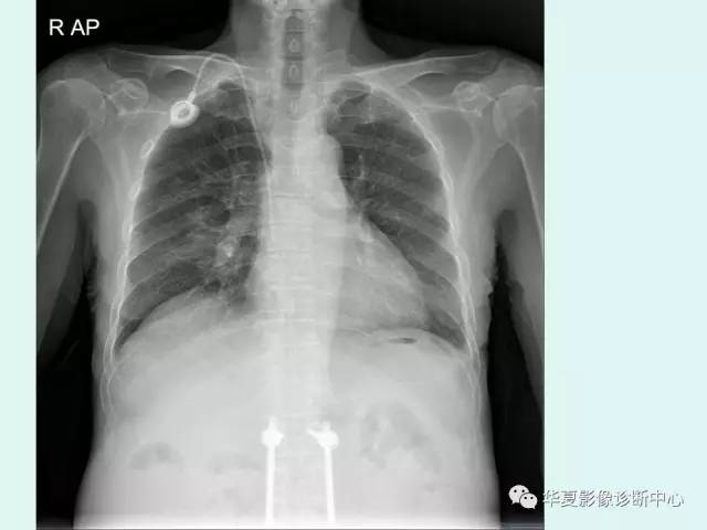 【PPT】输血相关急性肺损伤