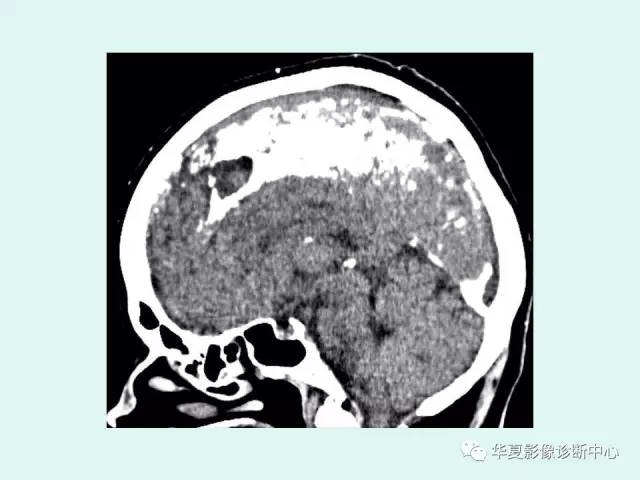 【PPT】痣样基底细胞癌综合征