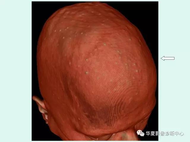 【PPT】痣样基底细胞癌综合征