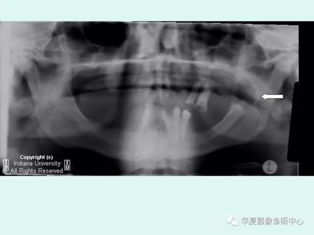 【PPT】痣样基底细胞癌综合征