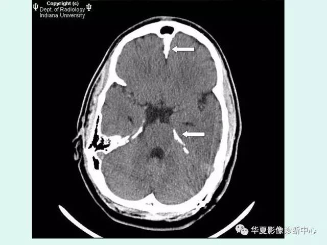 【PPT】痣样基底细胞癌综合征
