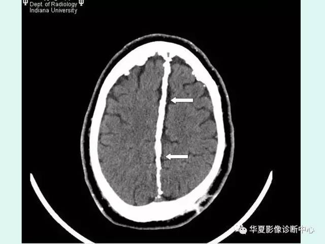 【PPT】痣样基底细胞癌综合征