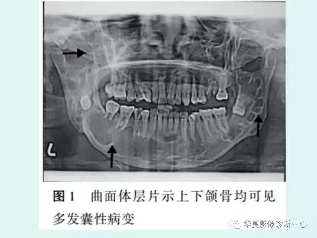 【PPT】痣样基底细胞癌综合征