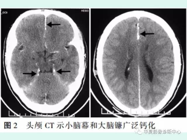 【PPT】痣样基底细胞癌综合征