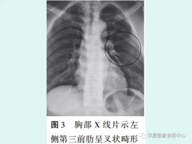 【PPT】痣样基底细胞癌综合征