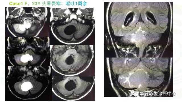 【PPT】血管母细胞瘤MR诊断及鉴别诊断