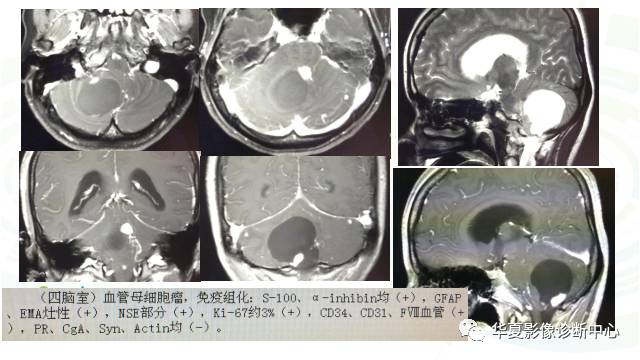 【PPT】血管母细胞瘤MR诊断及鉴别诊断