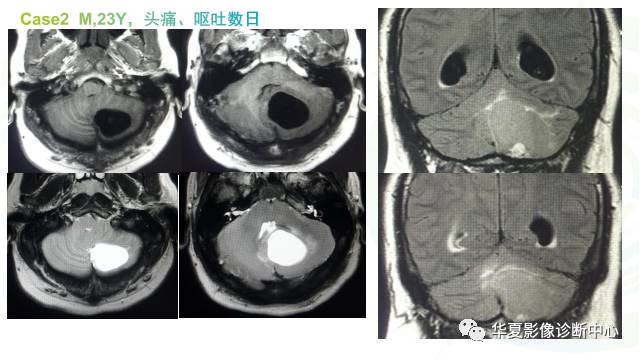 【PPT】血管母细胞瘤MR诊断及鉴别诊断