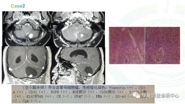 【PPT】血管母细胞瘤MR诊断及鉴别诊断