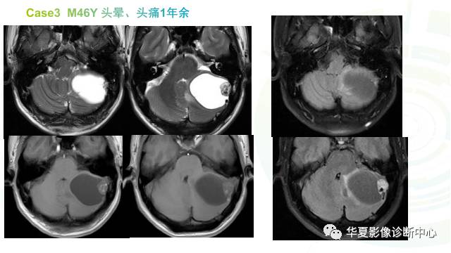 【PPT】血管母细胞瘤MR诊断及鉴别诊断