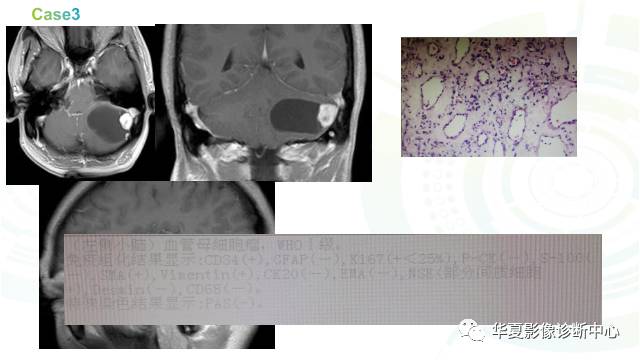 【PPT】血管母细胞瘤MR诊断及鉴别诊断