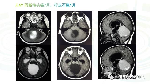 【PPT】血管母细胞瘤MR诊断及鉴别诊断