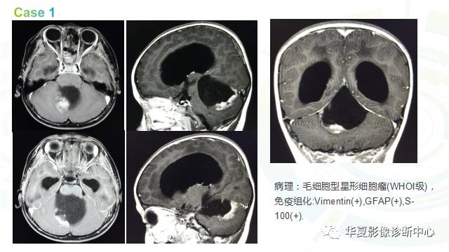 【PPT】血管母细胞瘤MR诊断及鉴别诊断