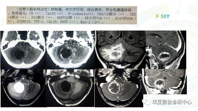 【PPT】血管母细胞瘤MR诊断及鉴别诊断