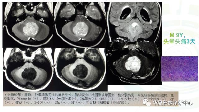 【PPT】血管母细胞瘤MR诊断及鉴别诊断