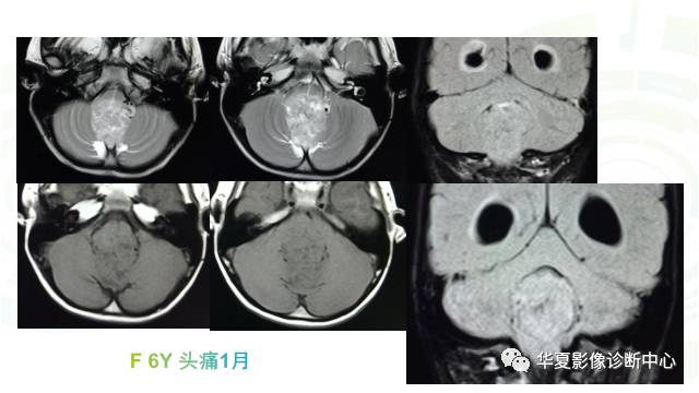 【PPT】血管母细胞瘤MR诊断及鉴别诊断