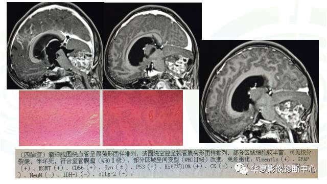 【PPT】血管母细胞瘤MR诊断及鉴别诊断